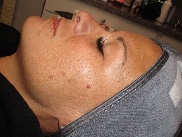 Microneedling Before & After