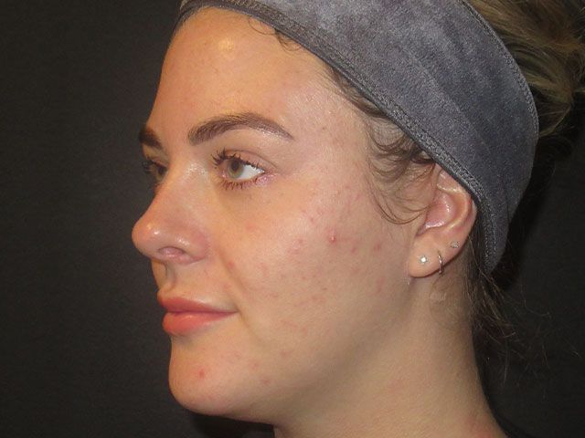 Microneedling Before & After