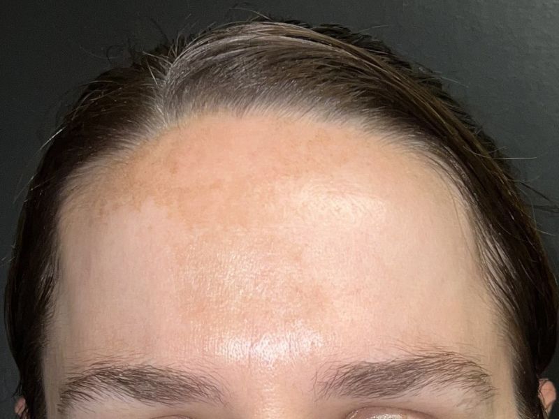 Microneedling with Exosomes Before & After
