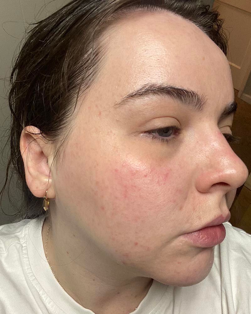 Microneedling with Exosomes Before & After