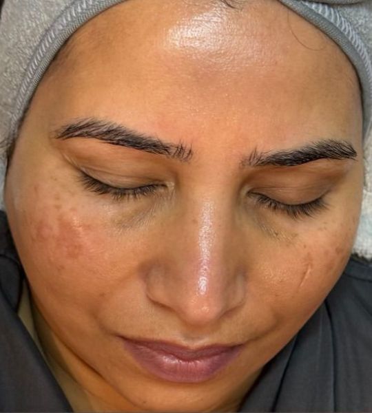 Microneedling Before & After