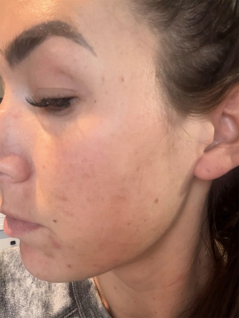 Microneedling with Exosomes Before & After