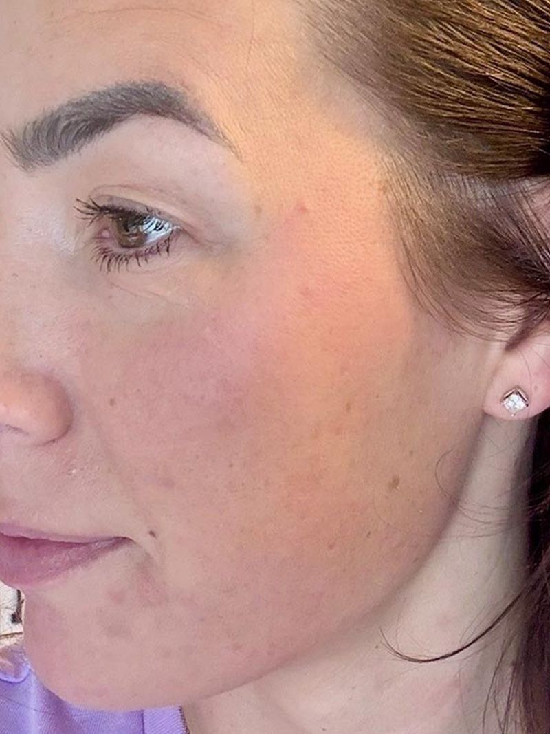 Microneedling with Exosomes Before & After