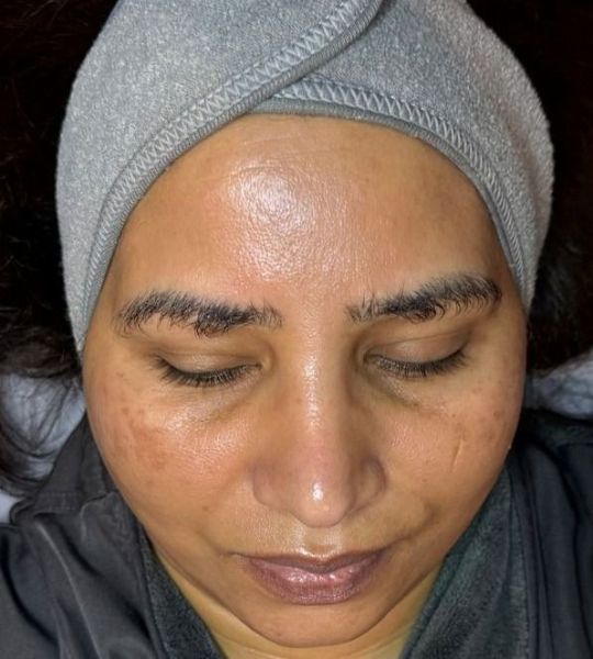 Microneedling Before & After