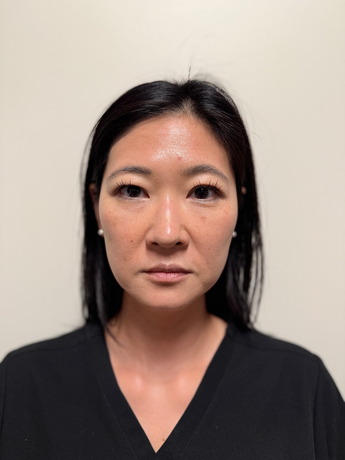 Microneedling with Exosomes Before & After