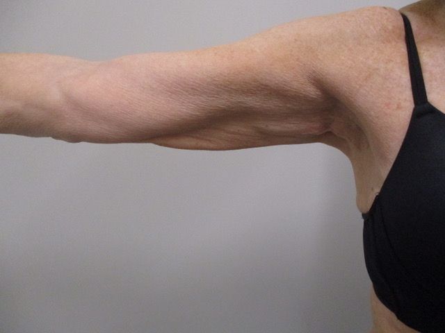 Brachioplasty Before & After