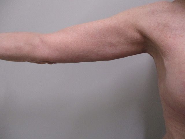 Brachioplasty Before & After