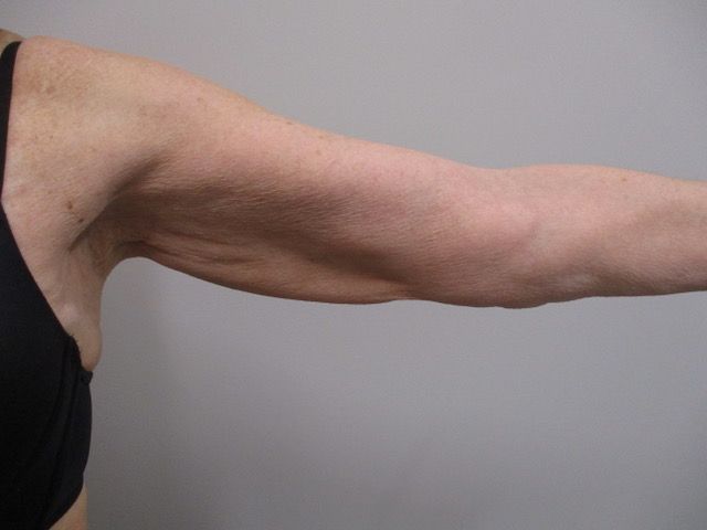 Brachioplasty Before & After