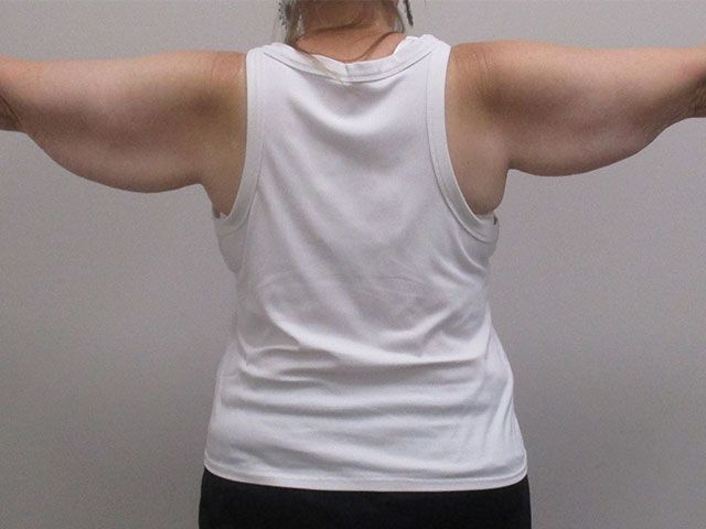 Brachioplasty Before & After