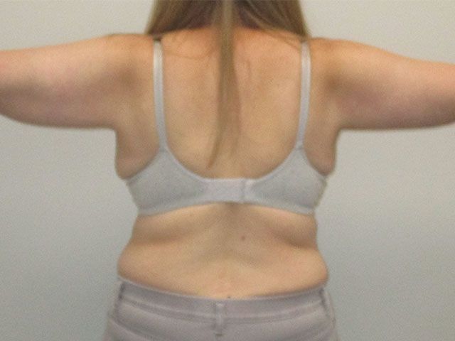 Brachioplasty Before & After