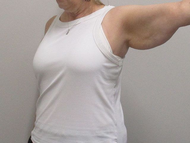Brachioplasty Before & After