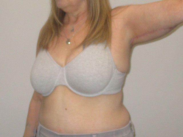Brachioplasty Before & After