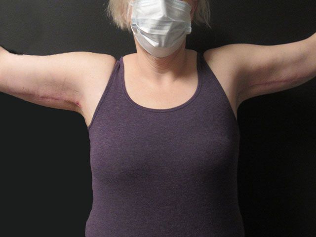 Brachioplasty Before & After