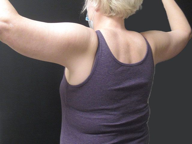 Brachioplasty Before & After