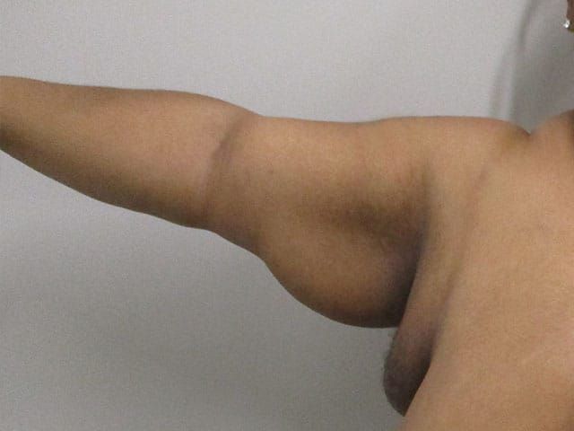 Brachioplasty Before & After