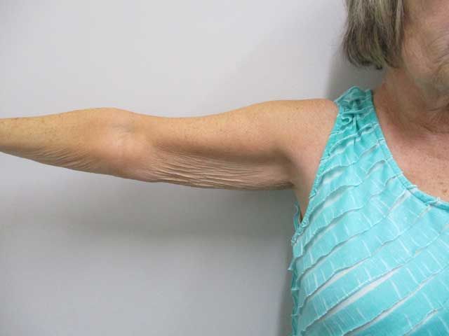 Brachioplasty Before & After