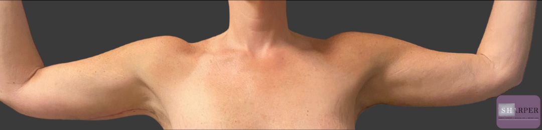 Brachioplasty Before & After