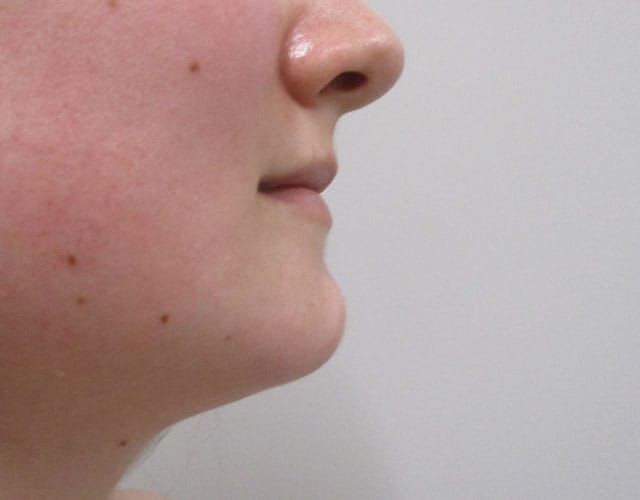 Chin Jawline Before & After