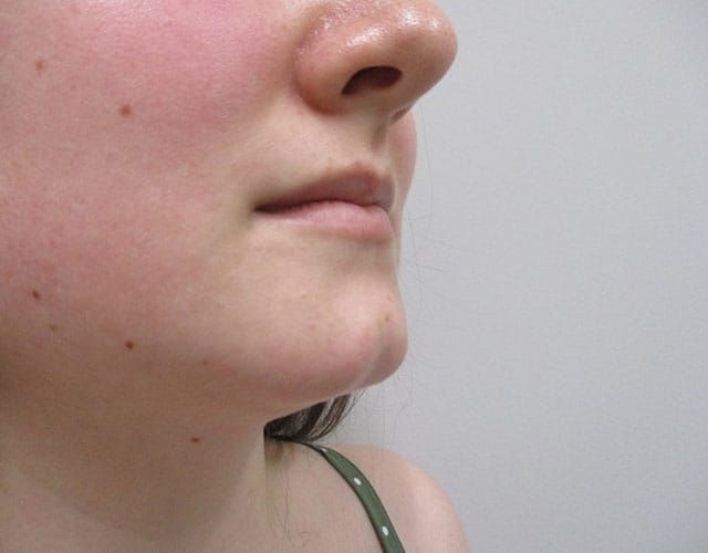 Chin Jawline Before & After
