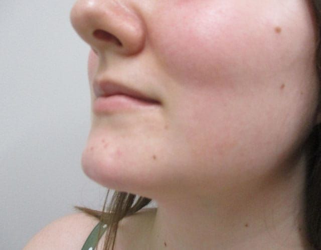 Chin Jawline Before & After