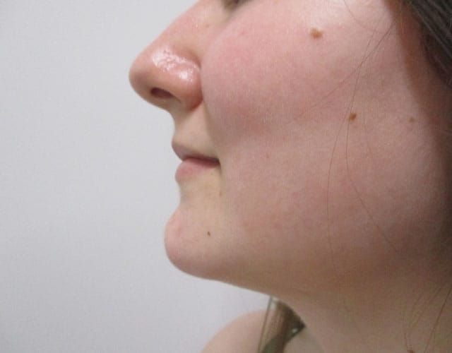 Chin Jawline Before & After