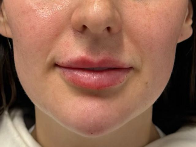 Chin Jawline Before & After