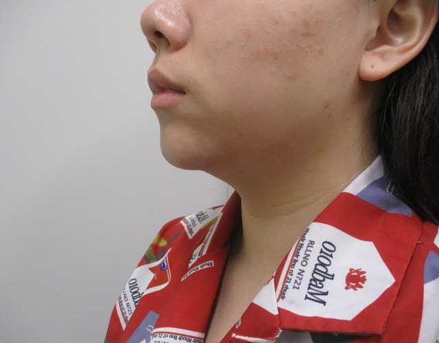 Chin Jawline Before & After