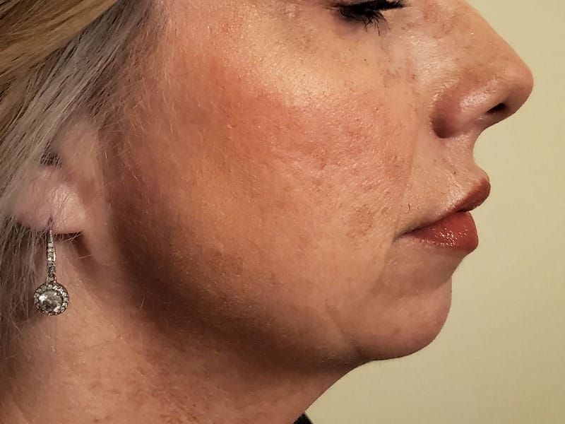 Chin Jawline Before & After