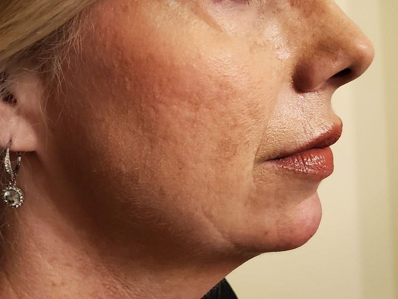 Chin Jawline Before & After