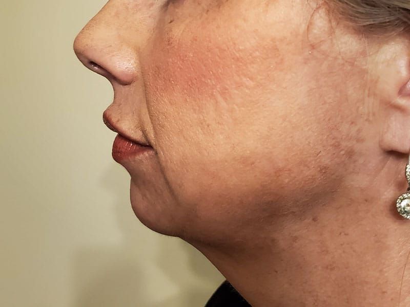 Chin Jawline Before & After