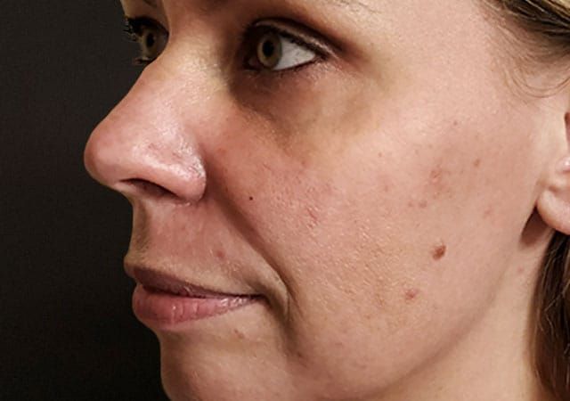 Chin Jawline Before & After