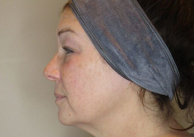 Chin Jawline Before & After