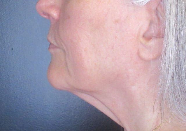 Chin Jawline Before & After