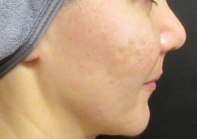 Chin Jawline Before & After