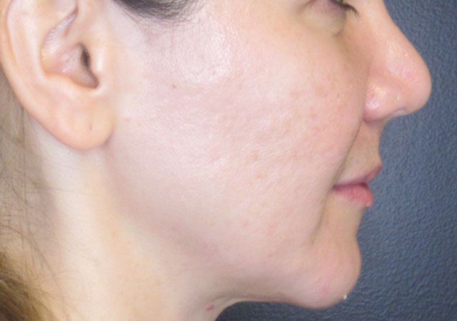 Chin Jawline Before & After