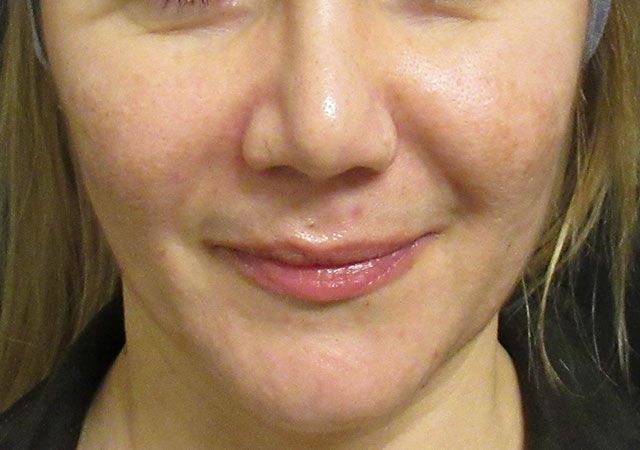 Chin Jawline Before & After