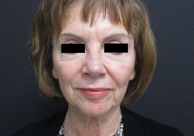 Chin Jawline Before & After