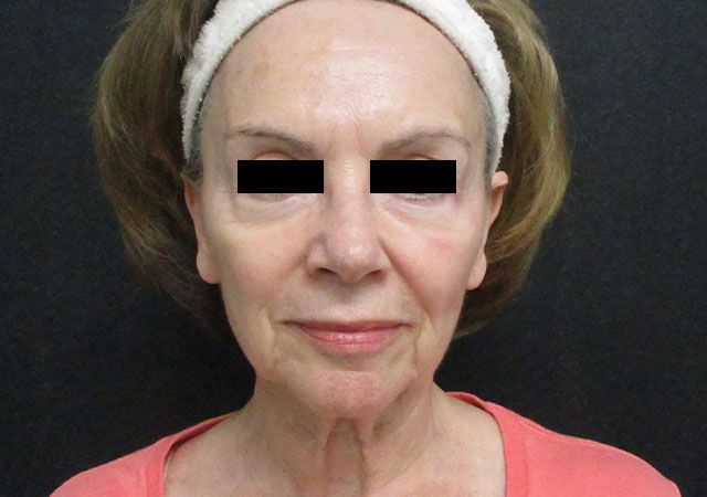 Chin Jawline Before & After