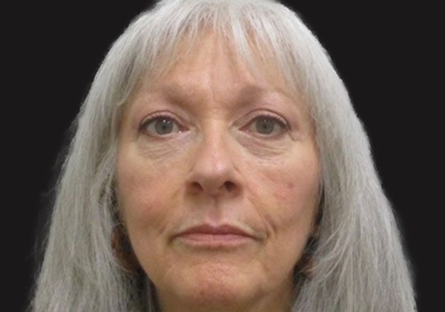 Chin Jawline Before & After