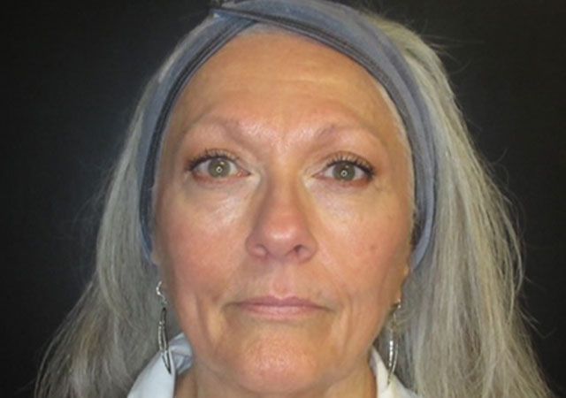 Chin Jawline Before & After