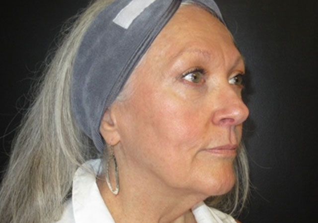 Chin Jawline Before & After