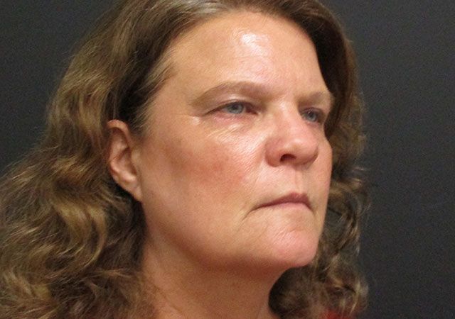 Chin Jawline Before & After