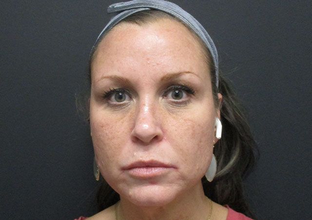 Chin Jawline Before & After