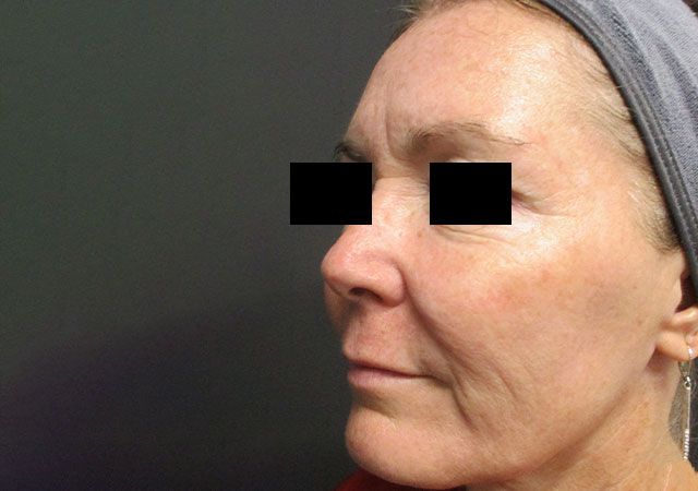 Chin Jawline Before & After