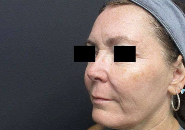 Chin Jawline Before & After