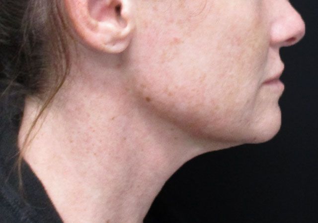 Chin Jawline Before & After