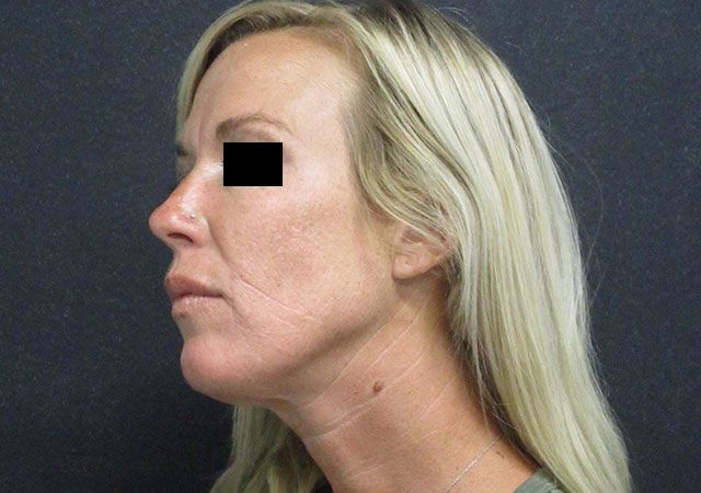 Chin Jawline Before & After