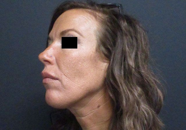 Chin Jawline Before & After