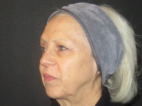 Chin Jawline Before & After