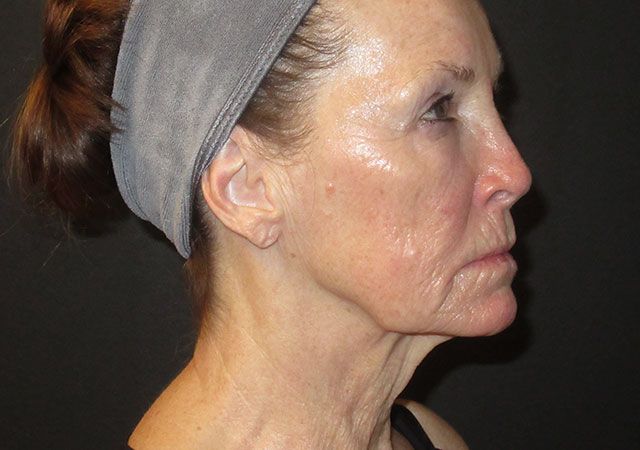 Chin Jawline Before & After